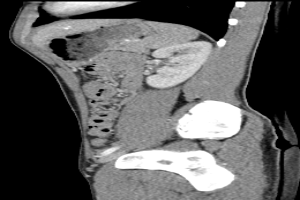 Eine MRT-Aufnahme eines Knies, die einen Bruch in der Mitte zeigt, umgeben von einem dunklen Hintergrund.